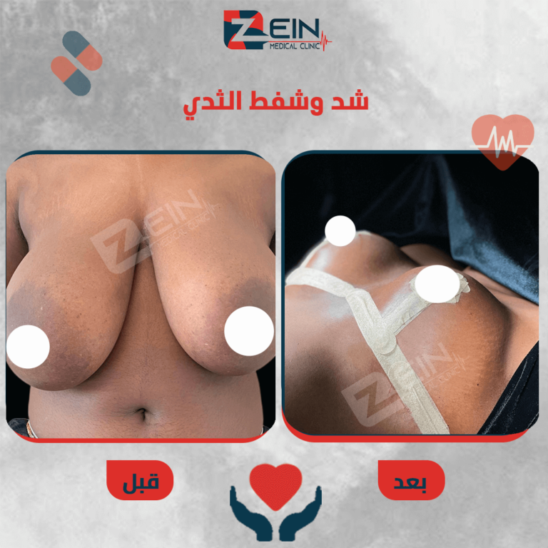 breast 5