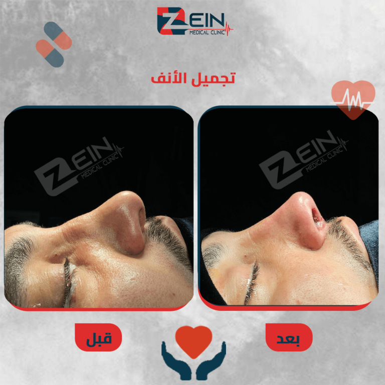 nose4